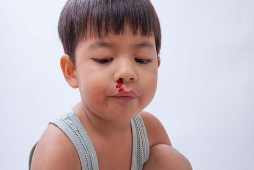 nosebleed